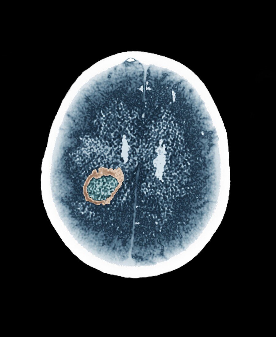 Brain abscess,CT scan