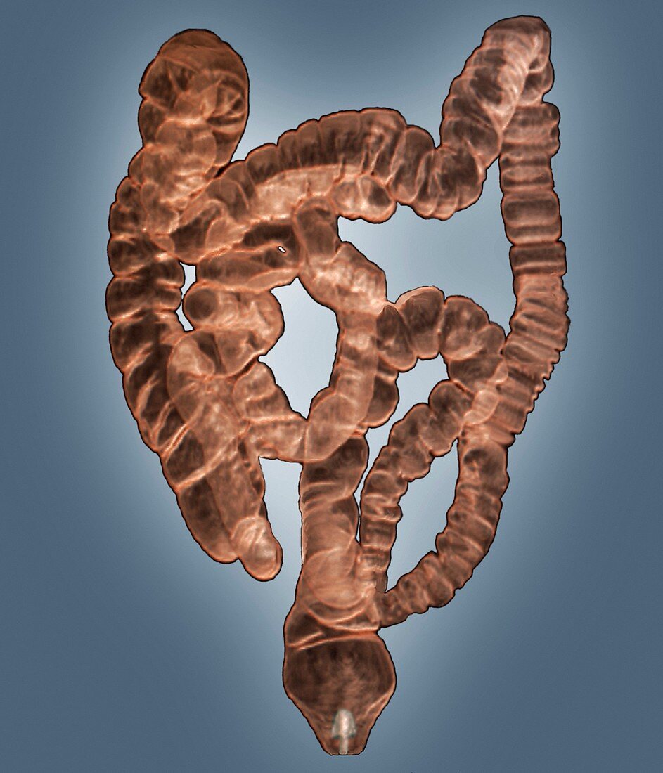 Normal intestines,3D CT scan