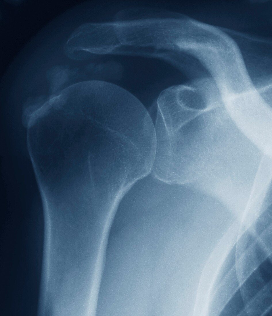 Tendinitis of the shoulder,X-ray
