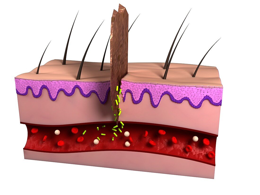 Wound infection,artwork