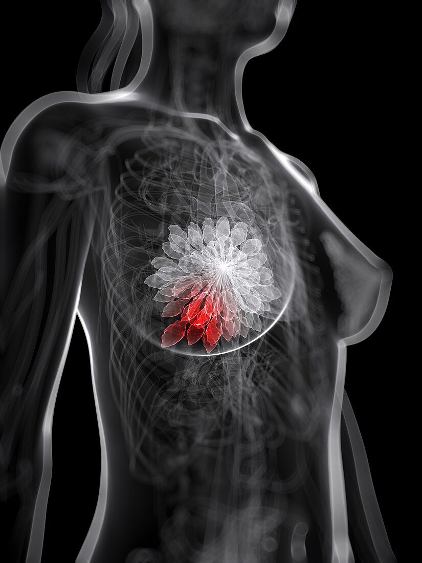Breast cancer,artwork