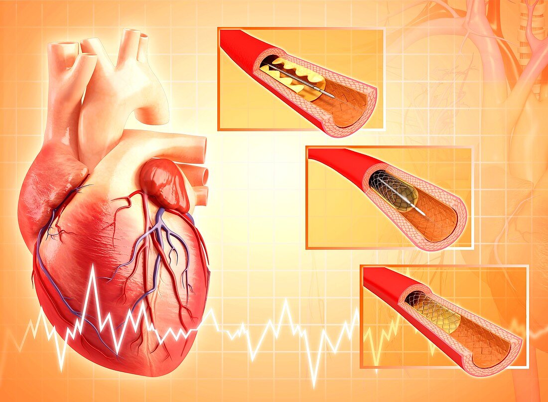 Angioplasty,artwork