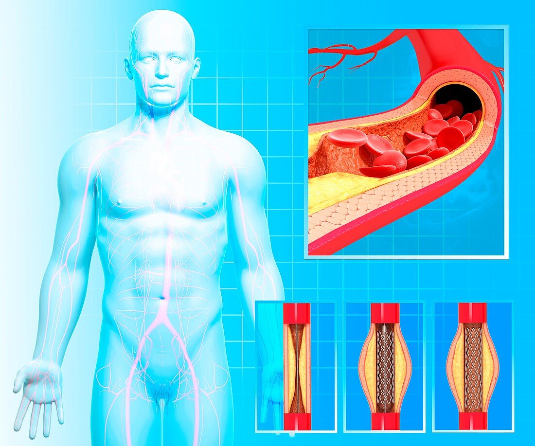 Angioplasty,artwork