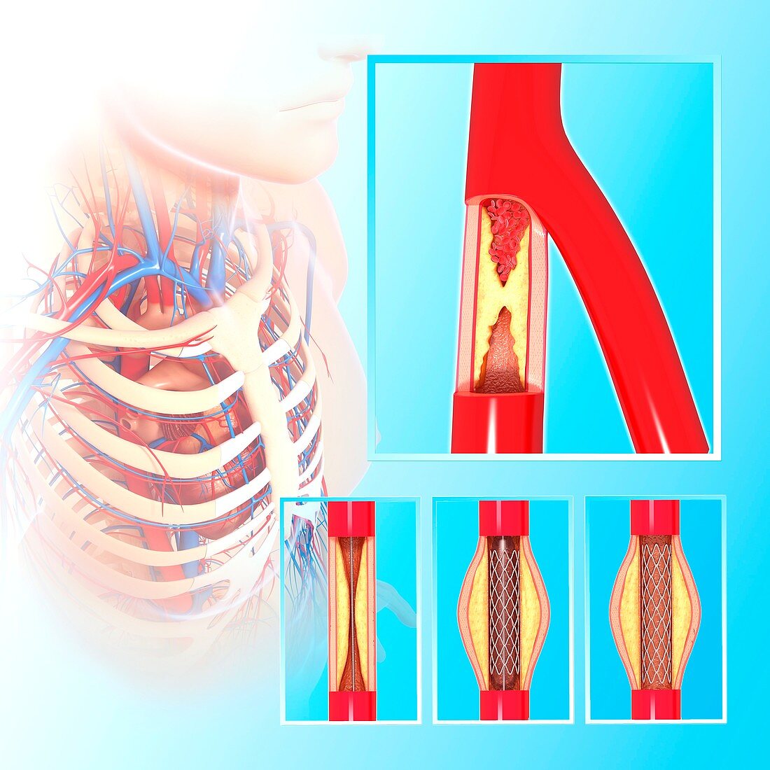 Angioplasty,artwork