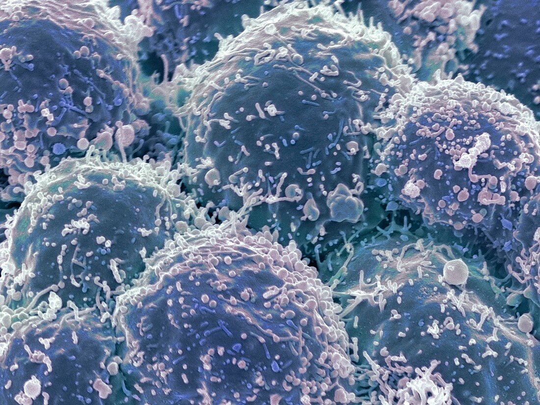 Lung cancer cells,SEM