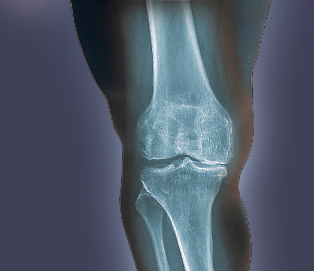 Arthritis of the knee,X-ray