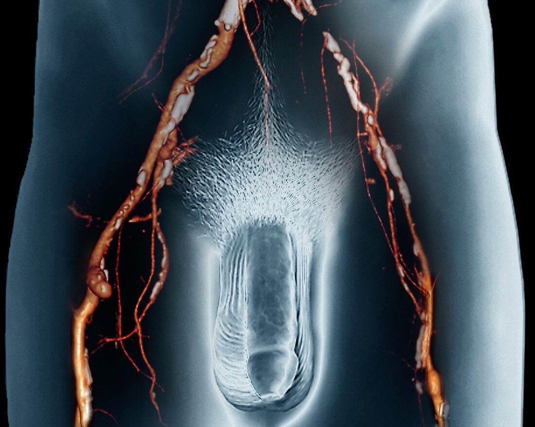 Narrowed arteries,3D CT scan