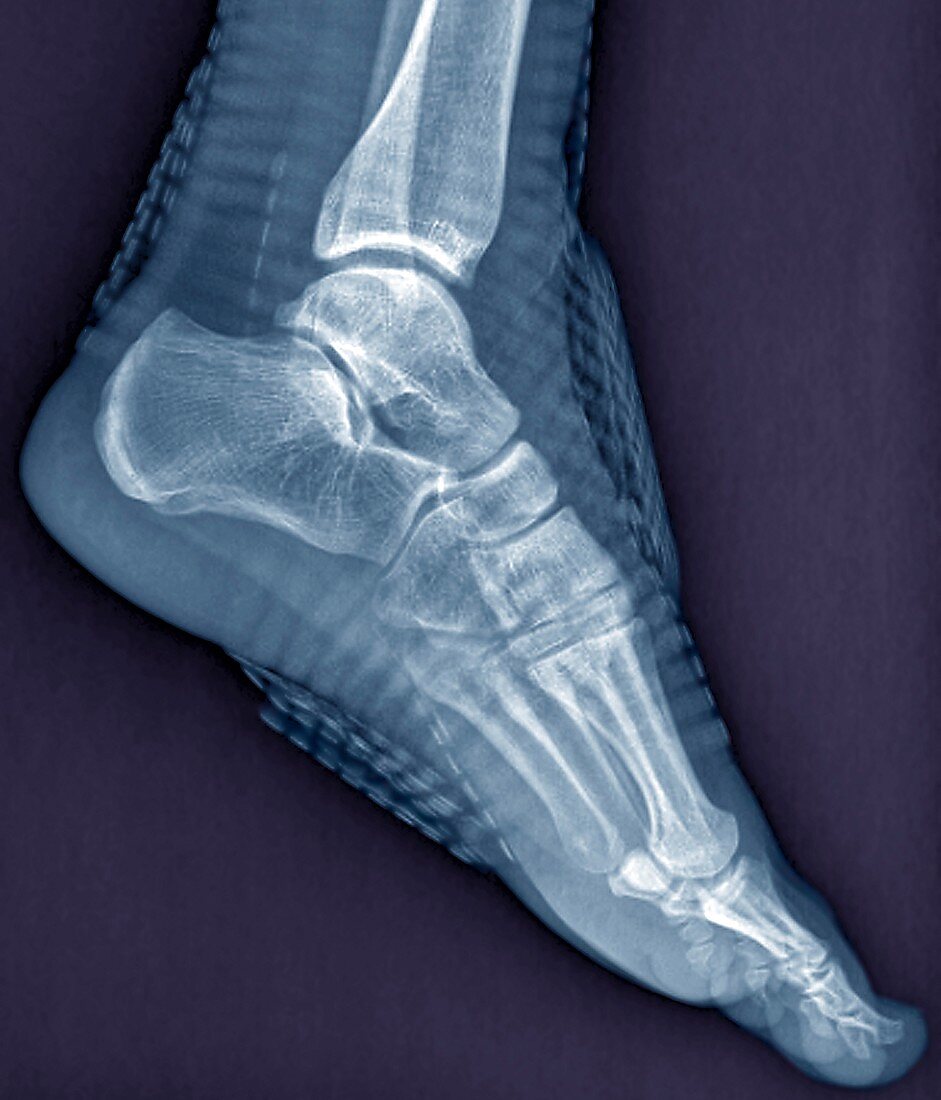 Healthy ankle joint,X-ray