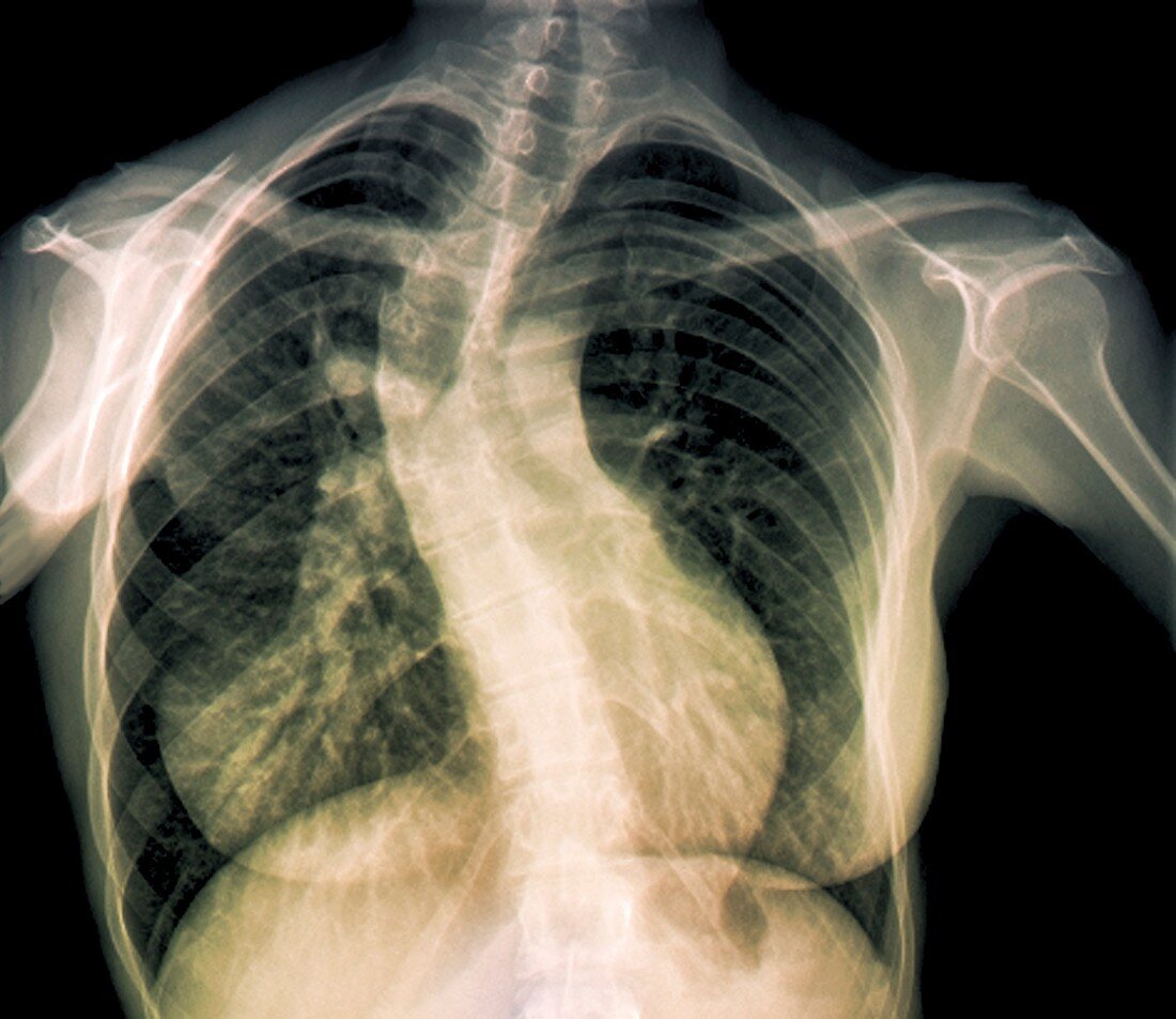 Scoliosis of the spine,X-ray