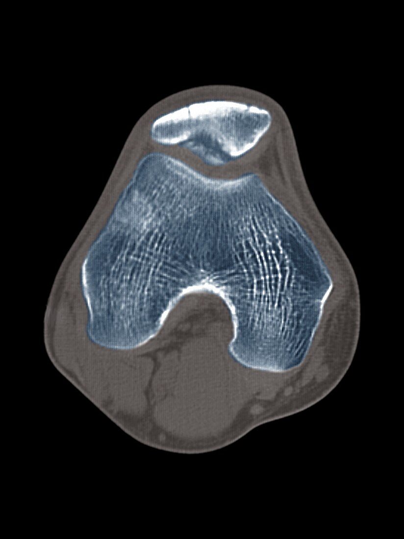 Knee disease,CT scan