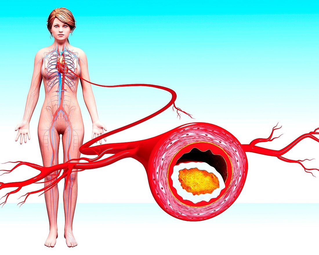 Atherosclerosis,artwork