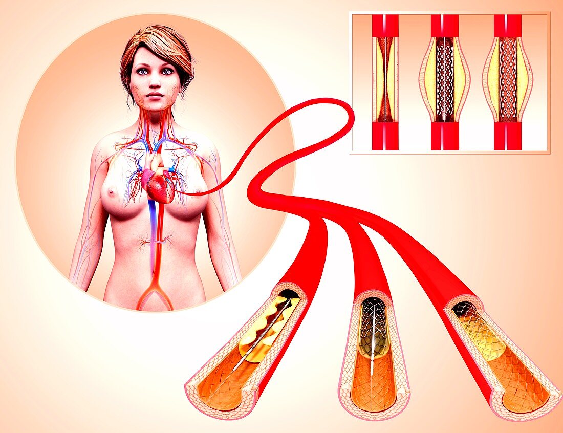 Angioplasty,artwork