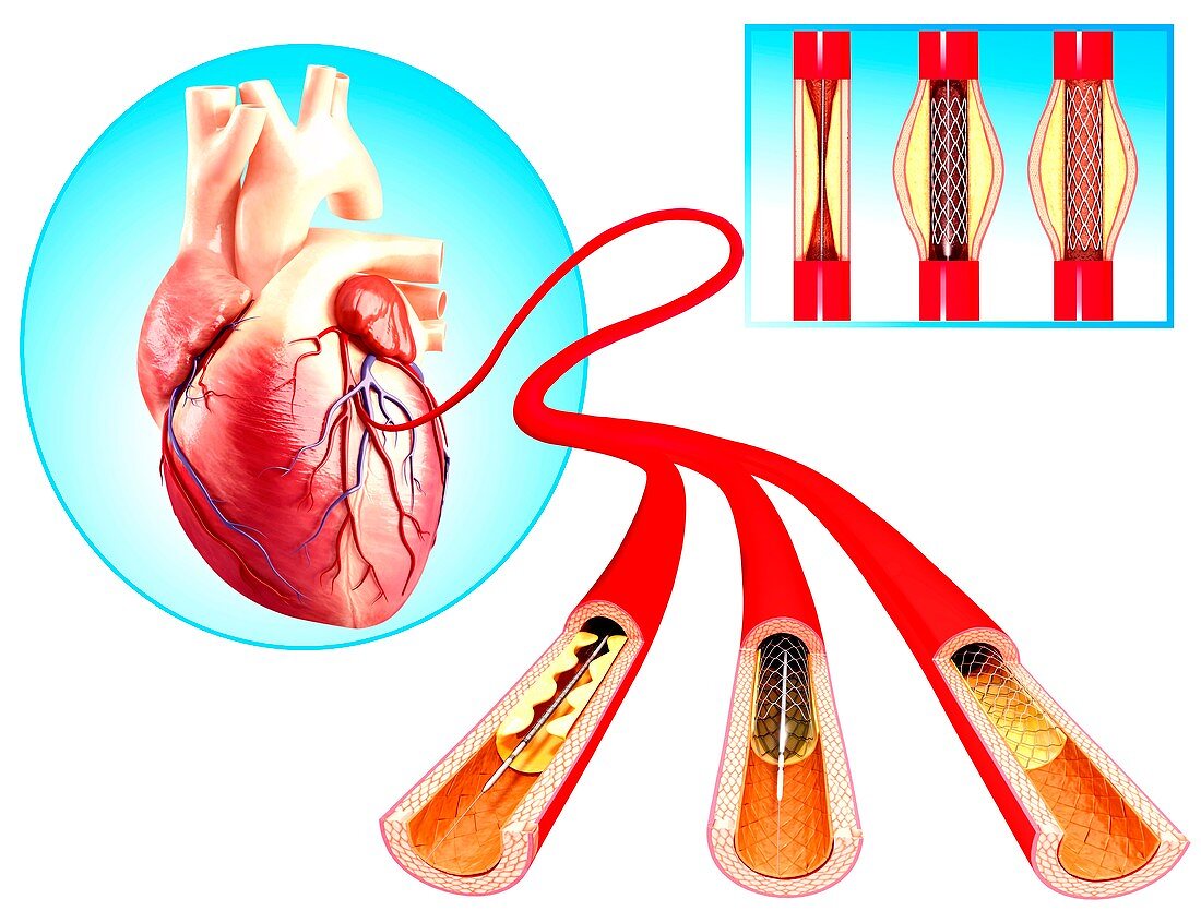 Angioplasty,artwork