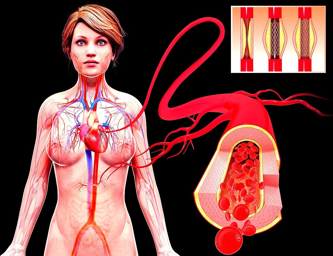 Angioplasty,artwork