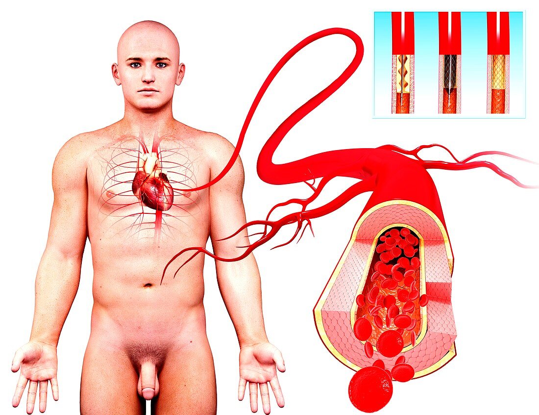 Angioplasty,artwork