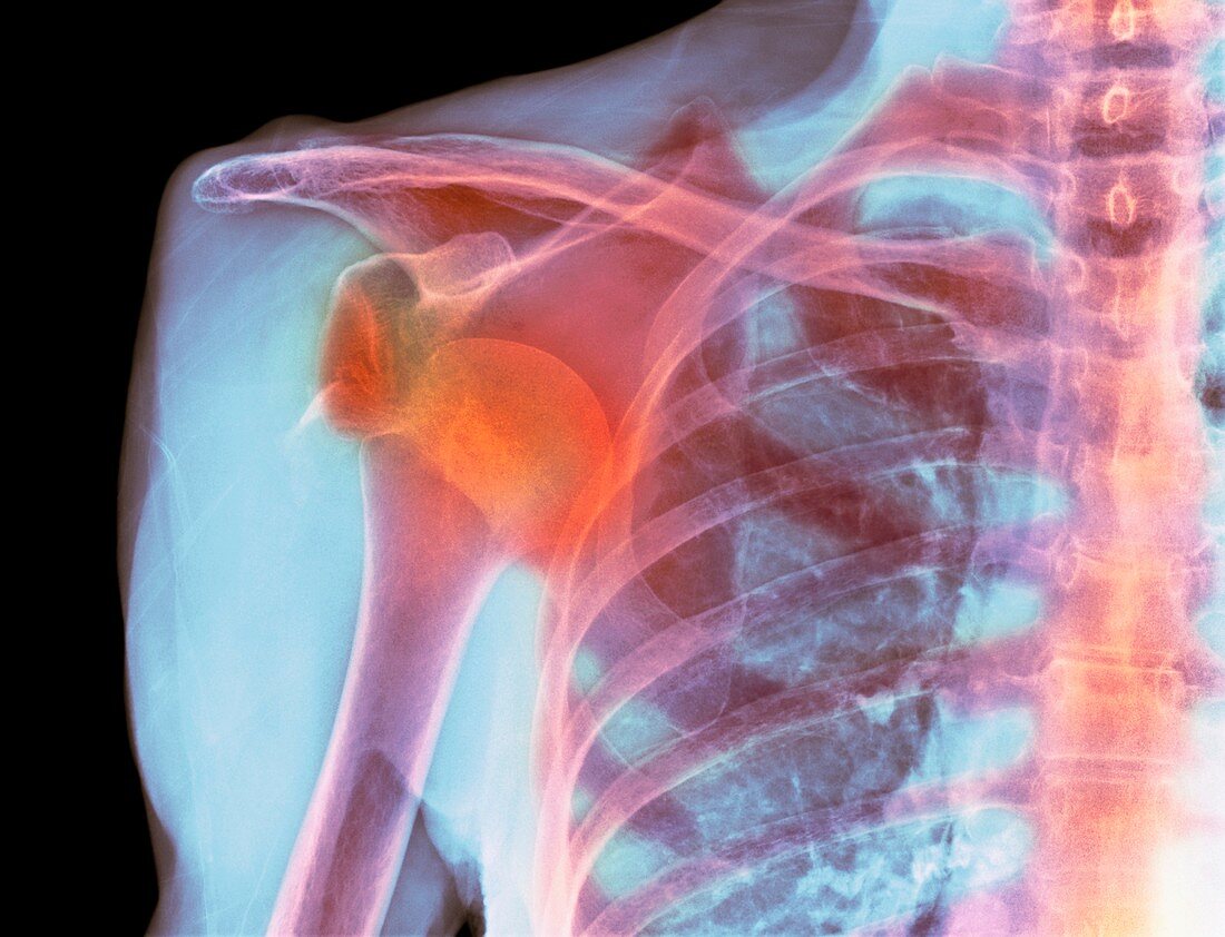 Dislocated shoulder,X-ray