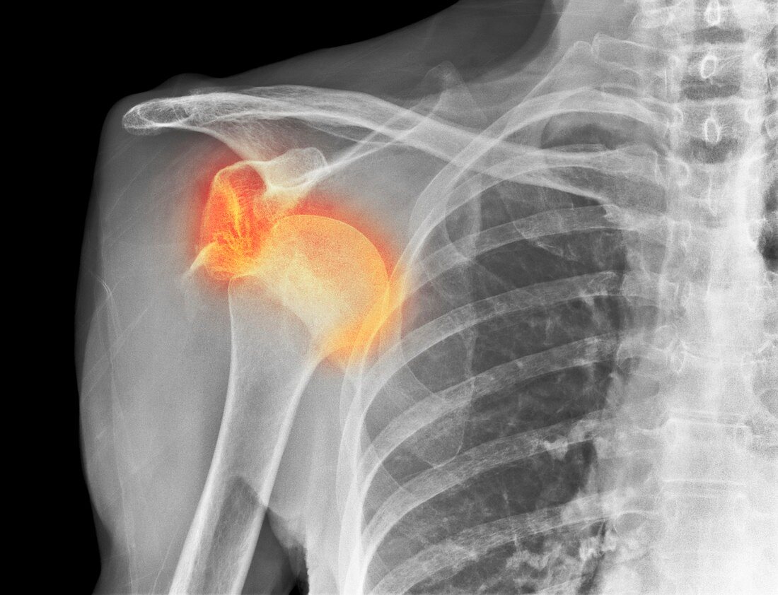 Dislocated shoulder,X-ray