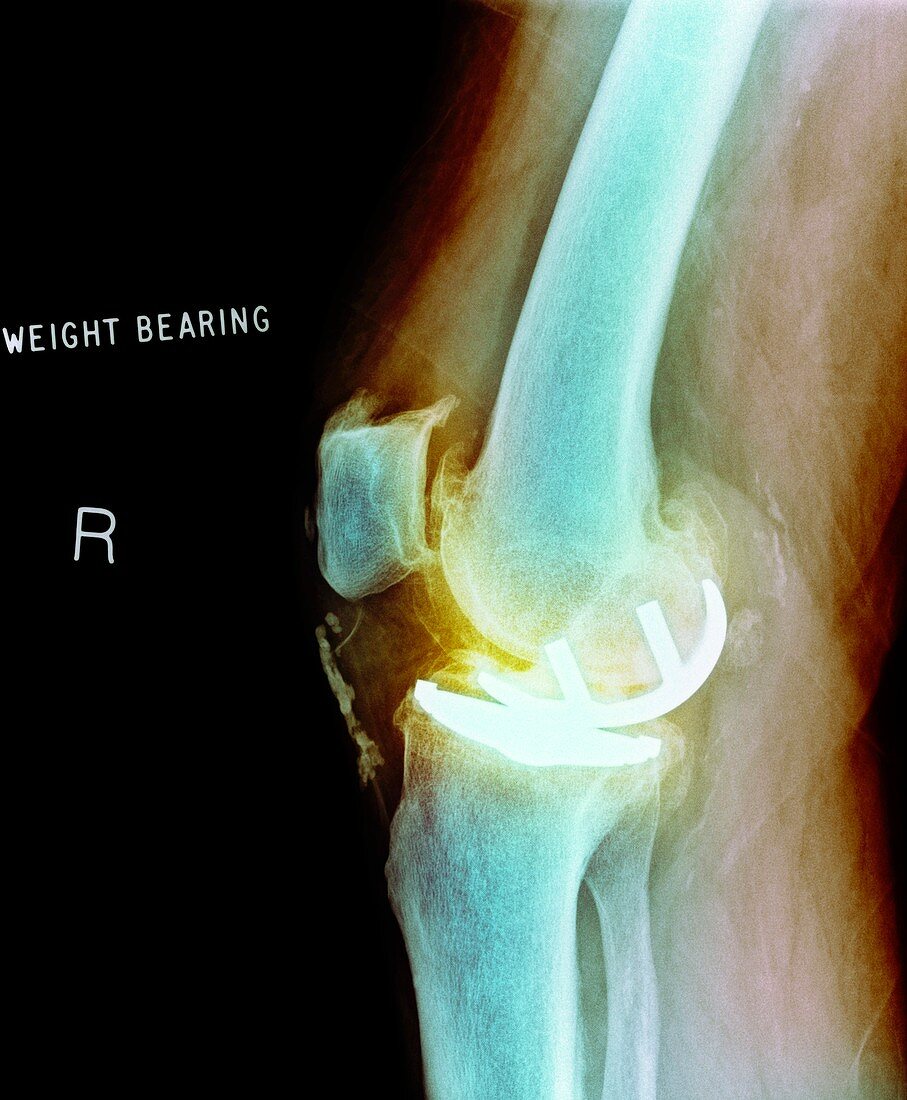 Osteoarthritis of the knee,X-ray