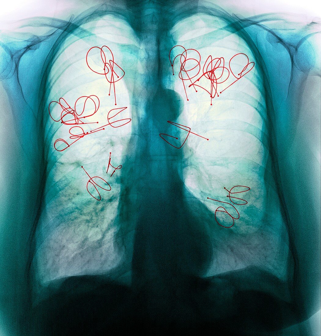 Endobronchial valves,X-ray