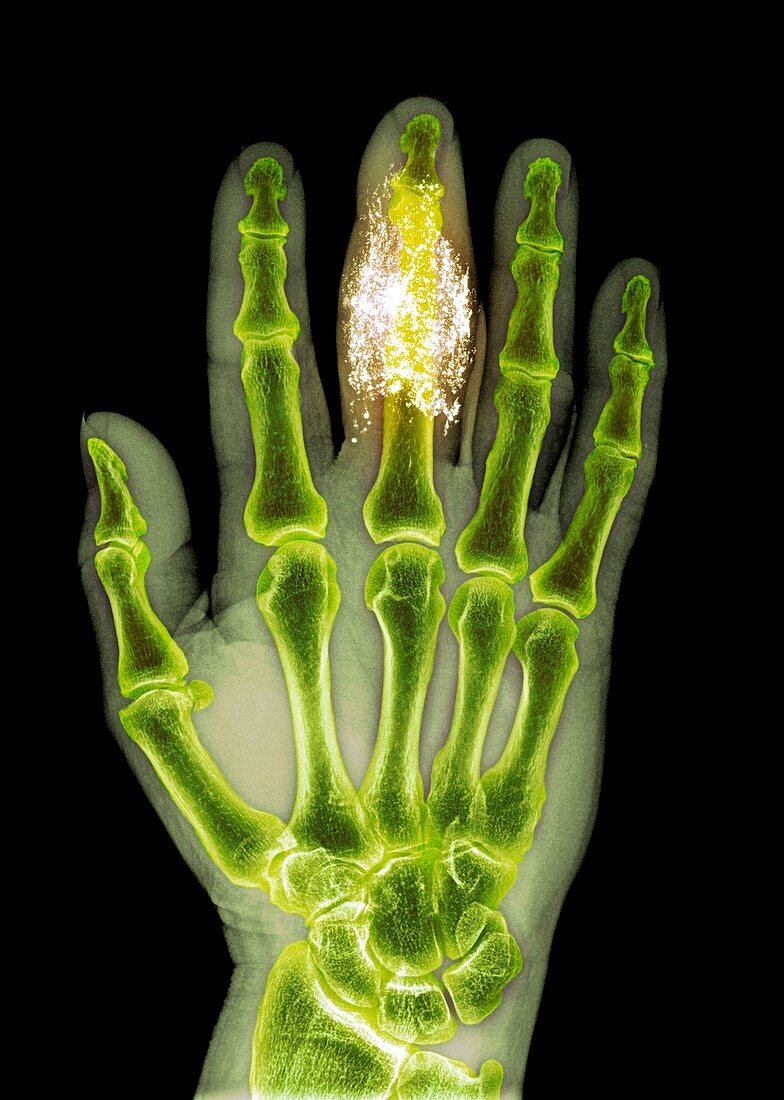 Foreign body in finger,X-ray