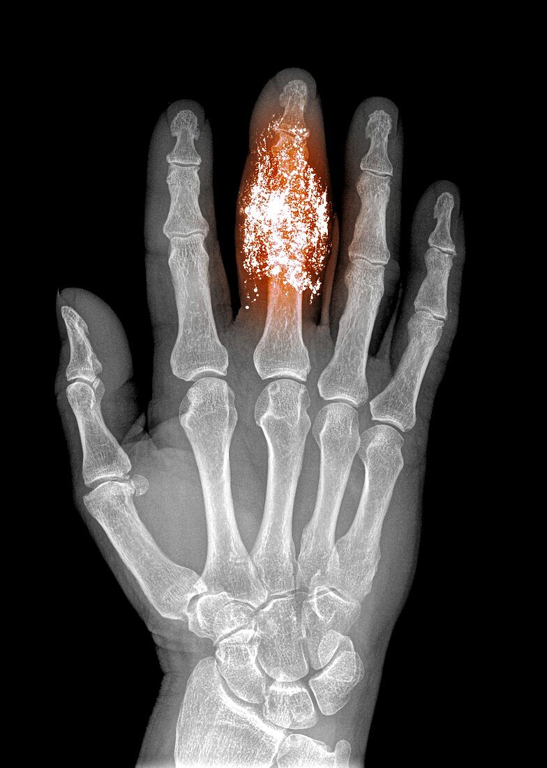 Foreign body in finger,X-ray