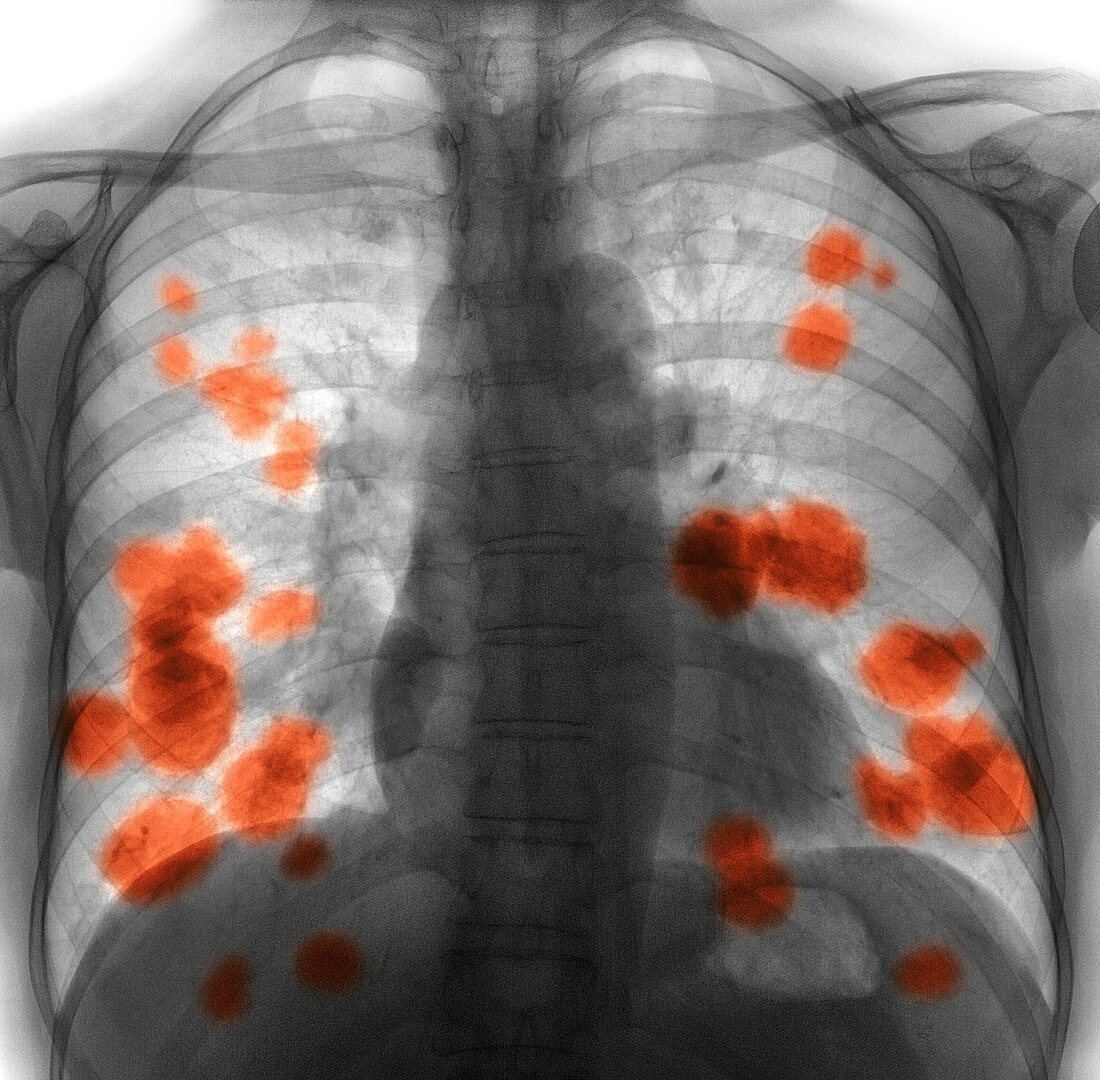 Secondary lung cancer,X-ray