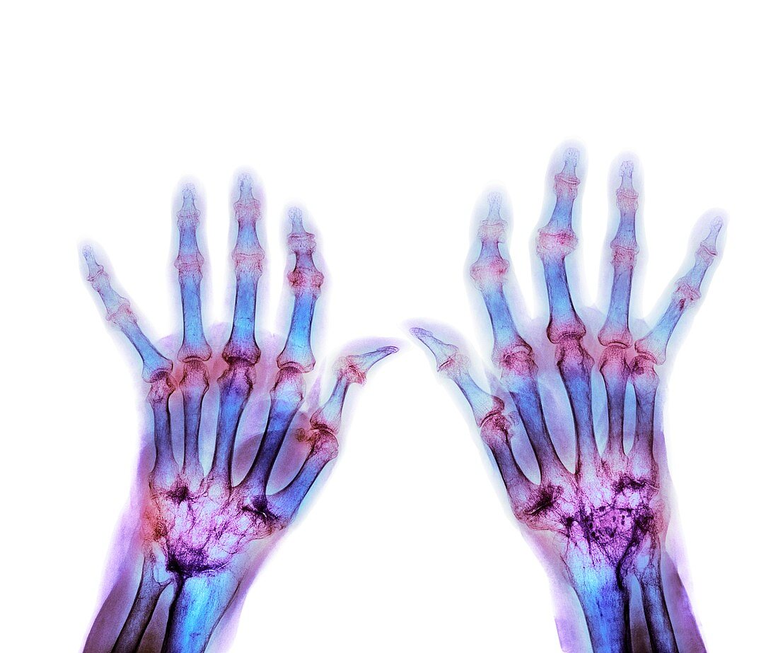 Rheumatoid arthritis,X-ray