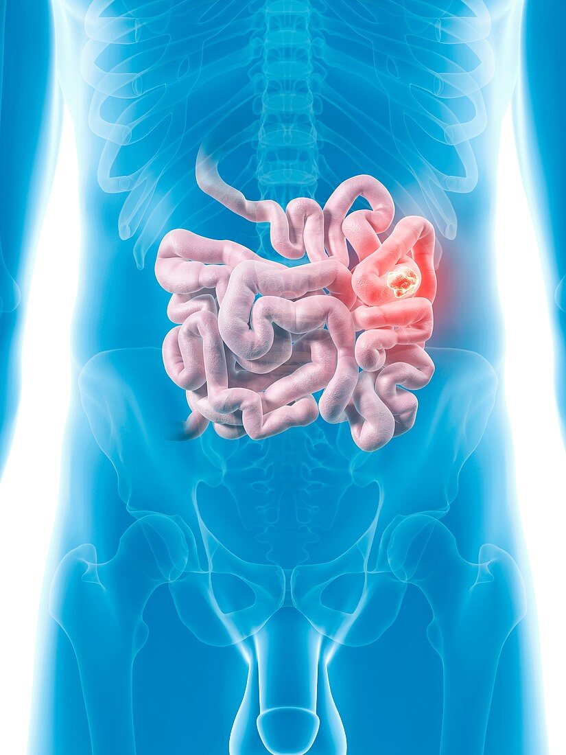 Tumor in small intestine,artwork