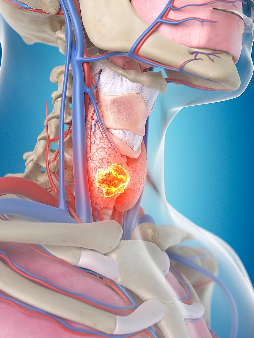 Tumor in human thyroid,artwork