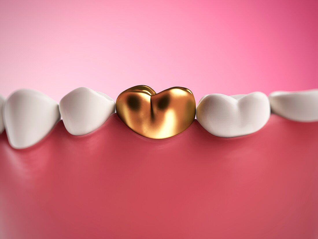 Gold filling in tooth,artwork