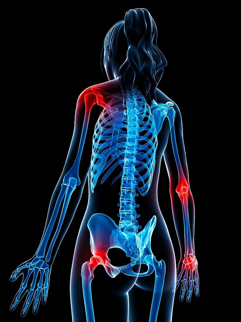 Human anatomy of inflamed joints,artwork