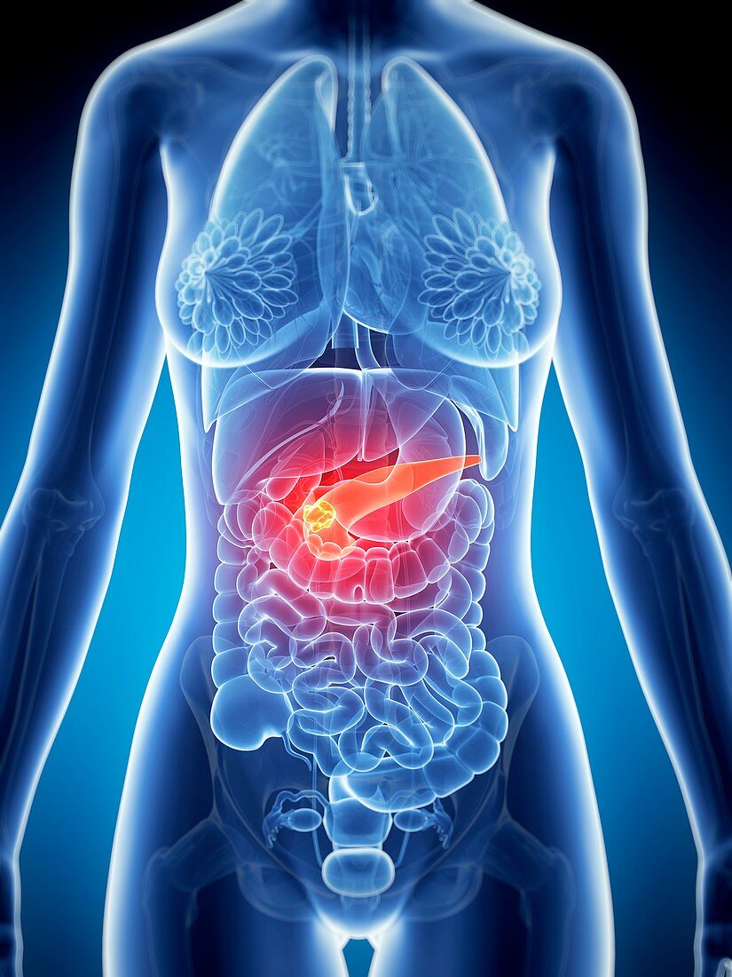 Female pancreas showing tumor,artwork