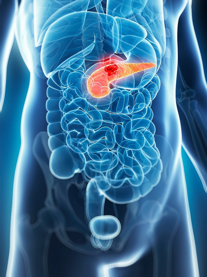 Human pancreas showing tumor,artwork