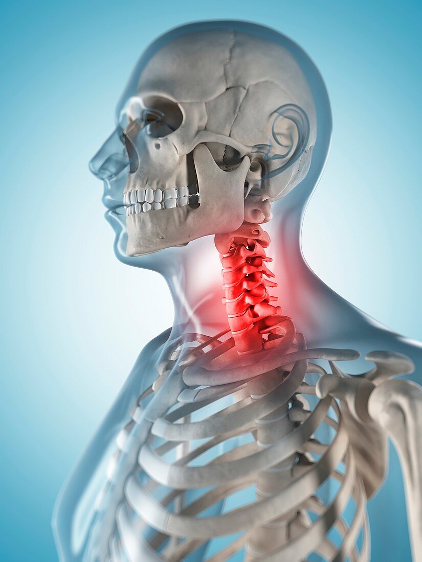 Human neck pain,artwork