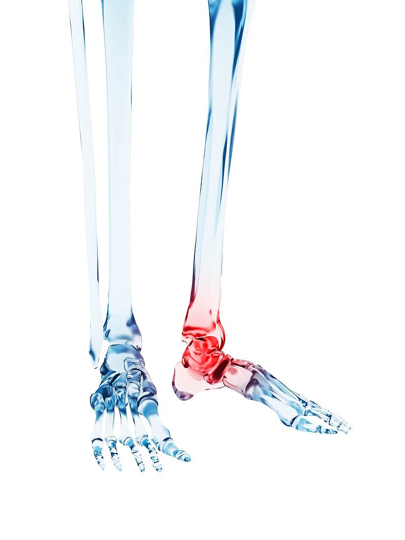 Human ankle pain,illustration