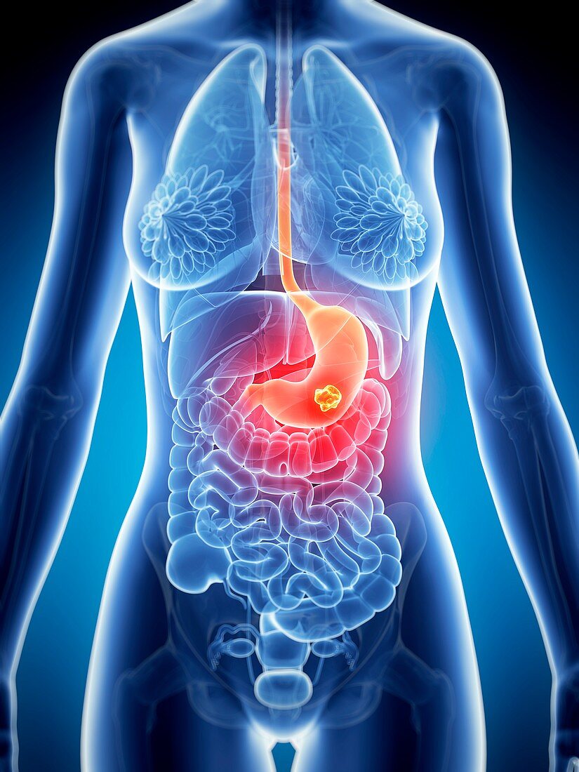 Female stomach cancer,illustration
