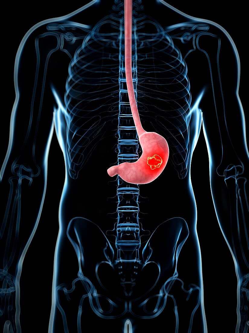 Human stomach cancer,illustration