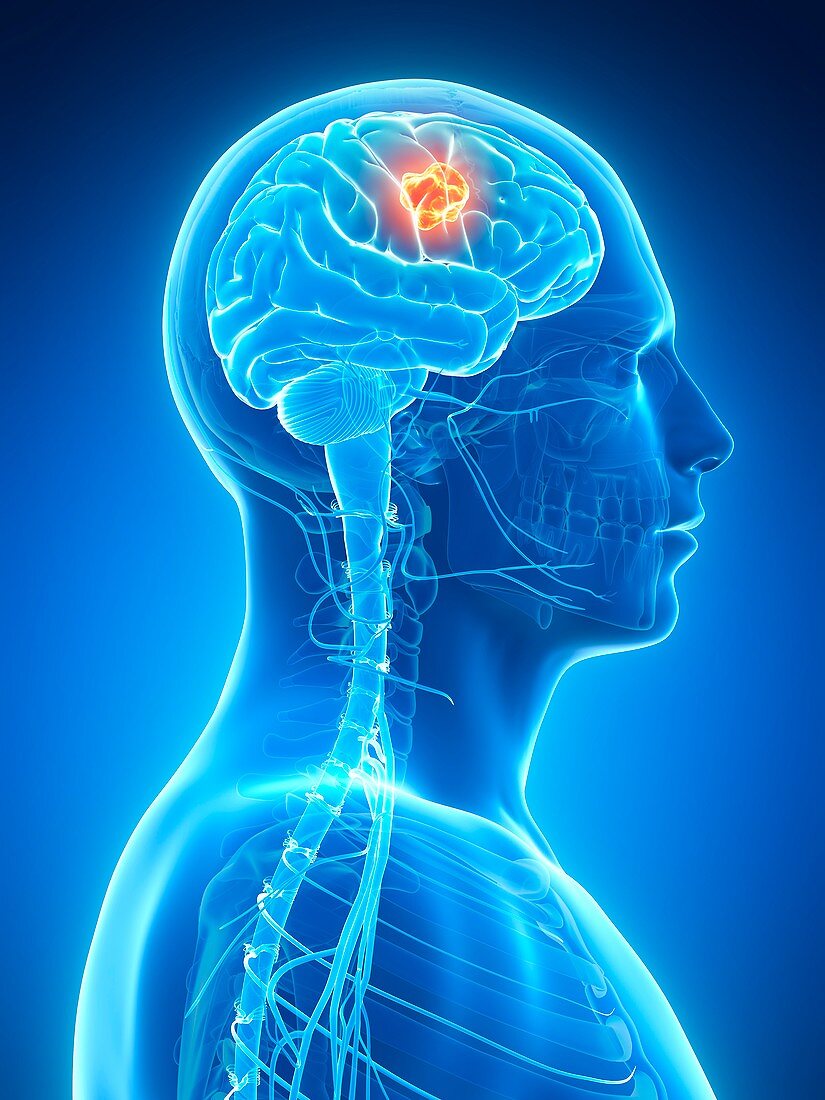 Human brain tumor,illustration