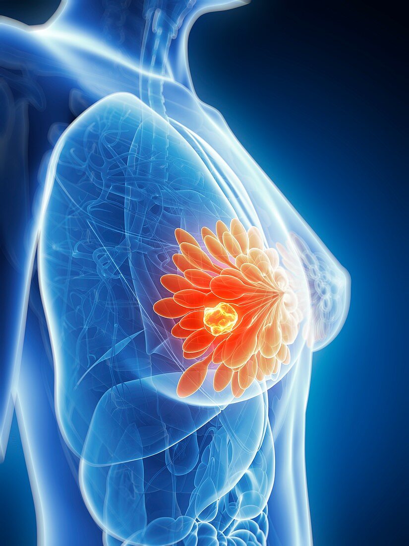 Human breast cancer,illustration