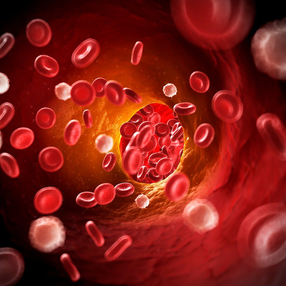 Arteriosclerosis,illustration