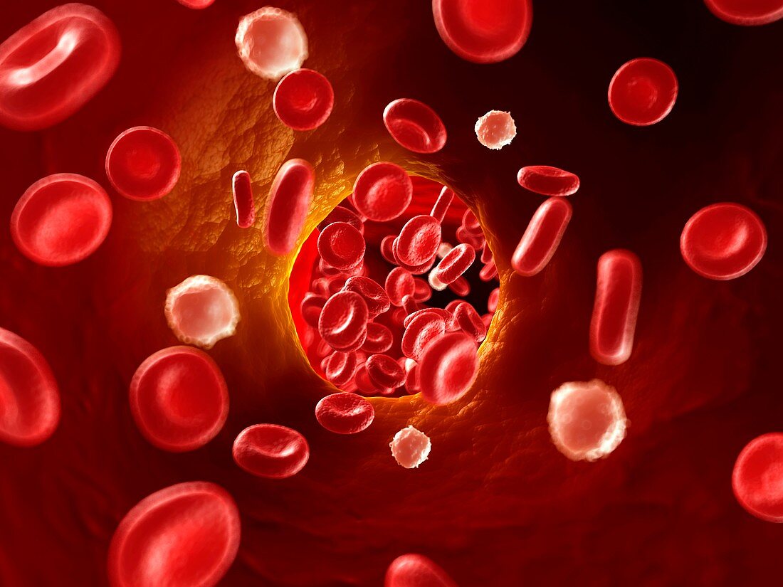 Arteriosclerosis,illustration