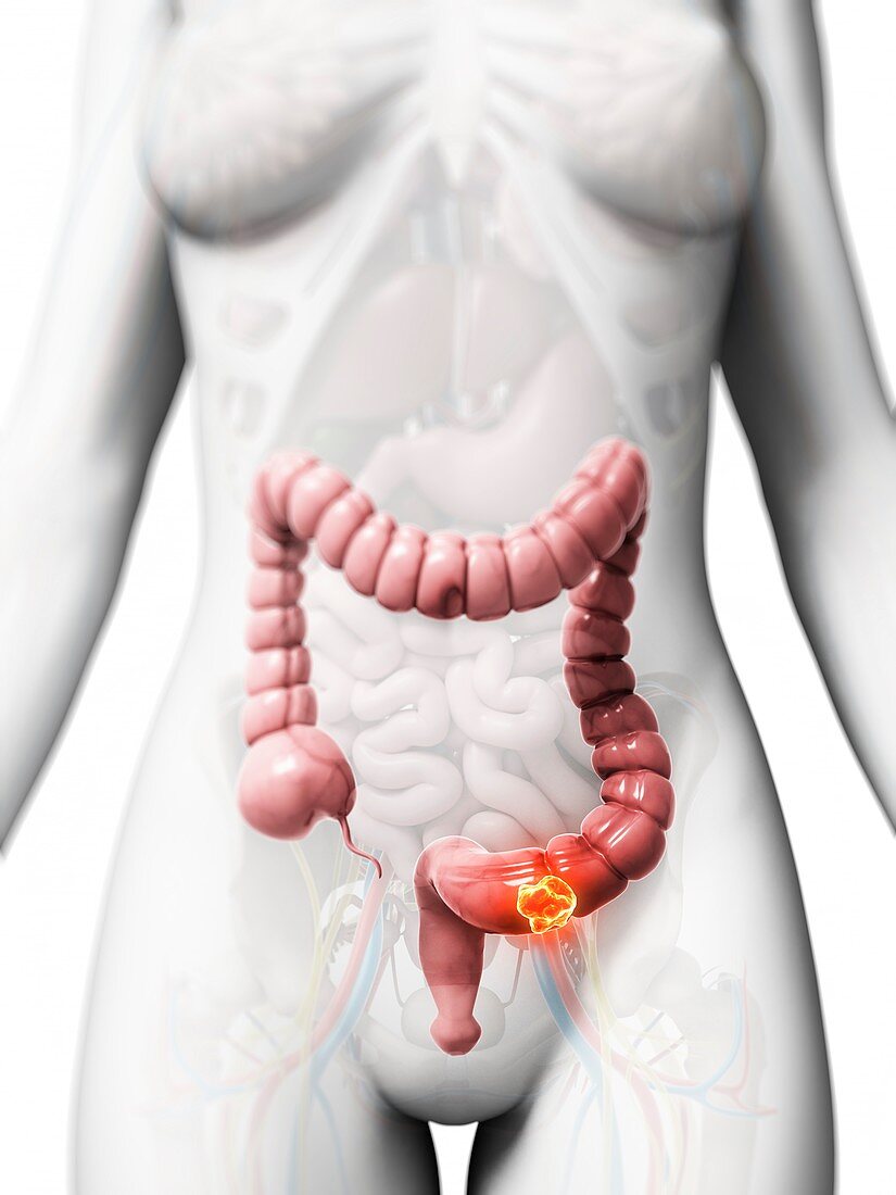 Human colon cancer,illustration