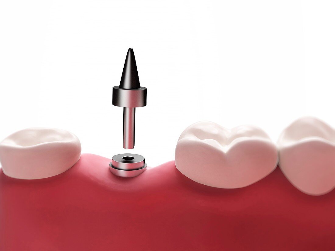Dental implant,illustration
