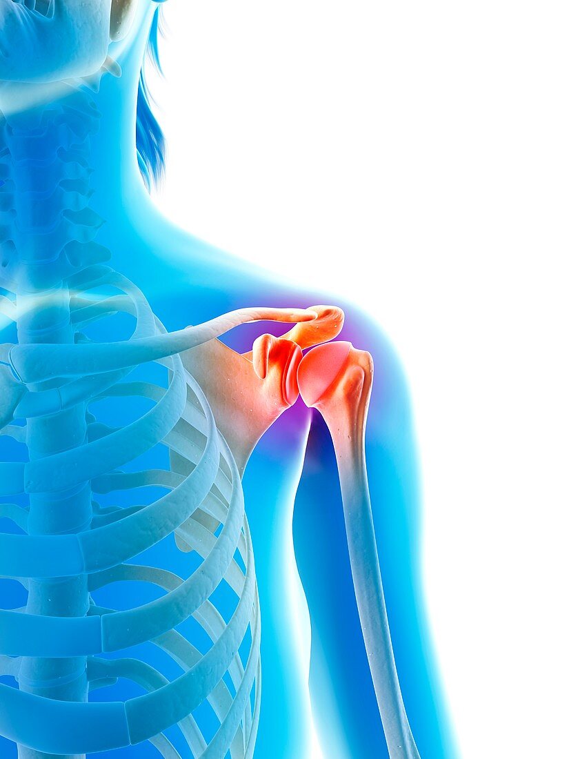 Inflamed human shoulder,illustration