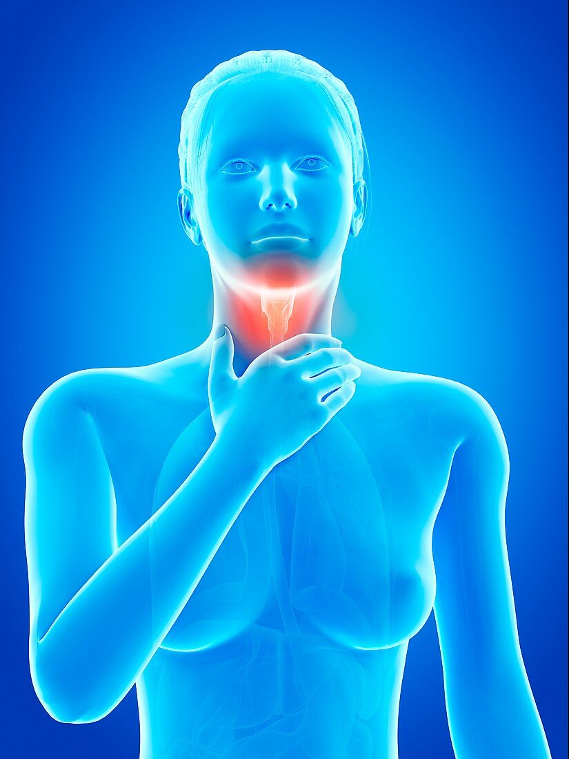 Inflammation of the larynx,illustration