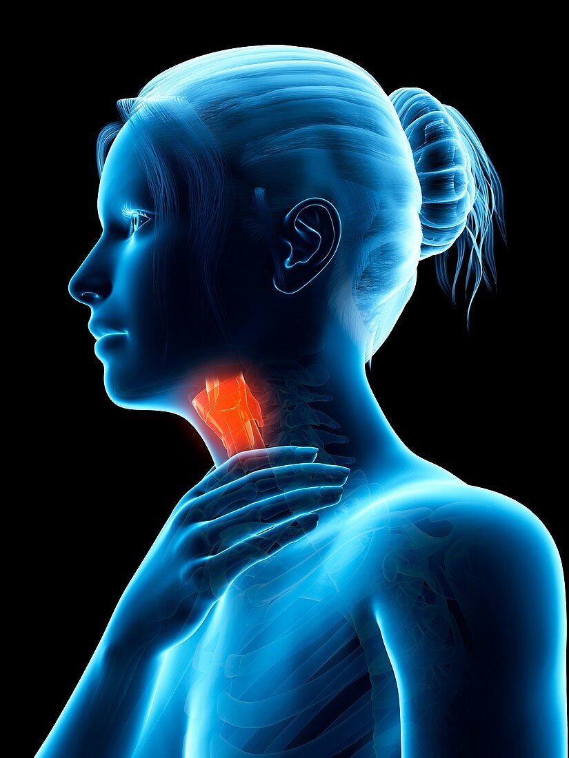 Inflammation of the larynx,illustration