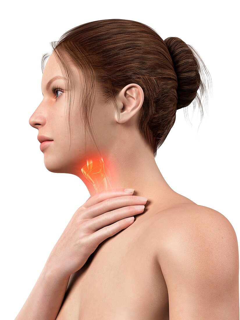 Inflammation of the larynx,illustration