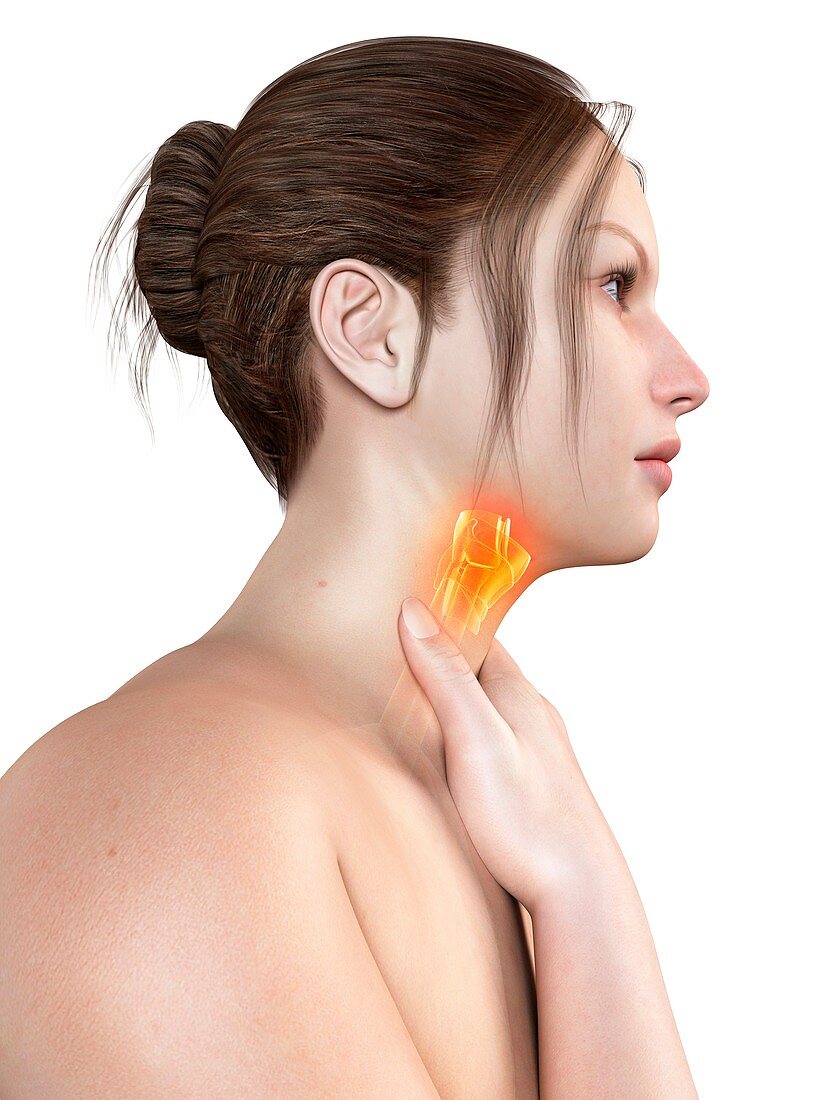 Inflammation of the larynx,illustration