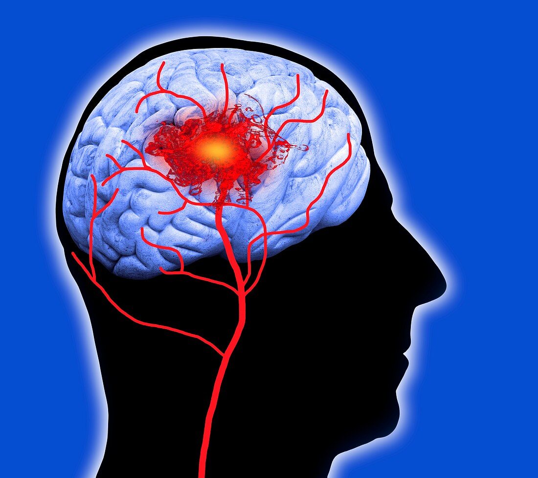 Human brain showing stroke