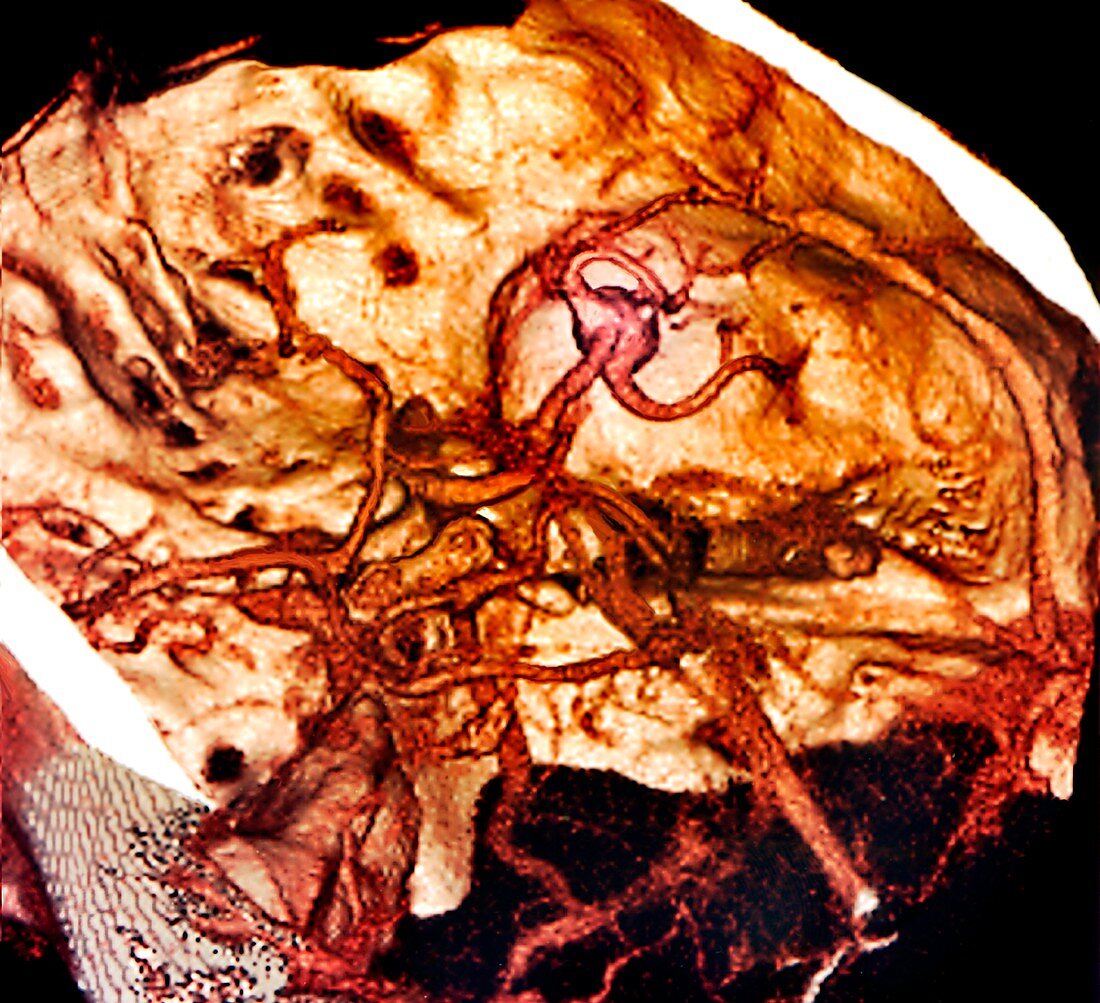 Brain haemorrhage,3D angiogram